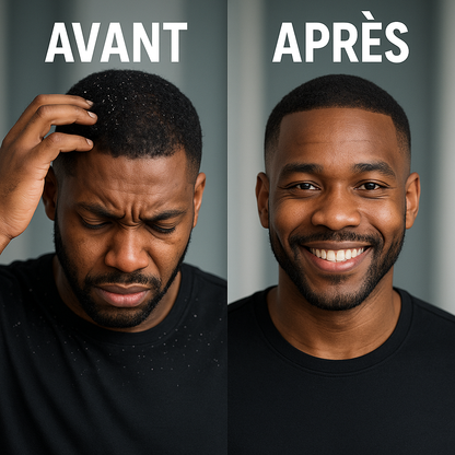 Zevra -Crème de éliminer la dermatite, le psoriasis et les pellicules