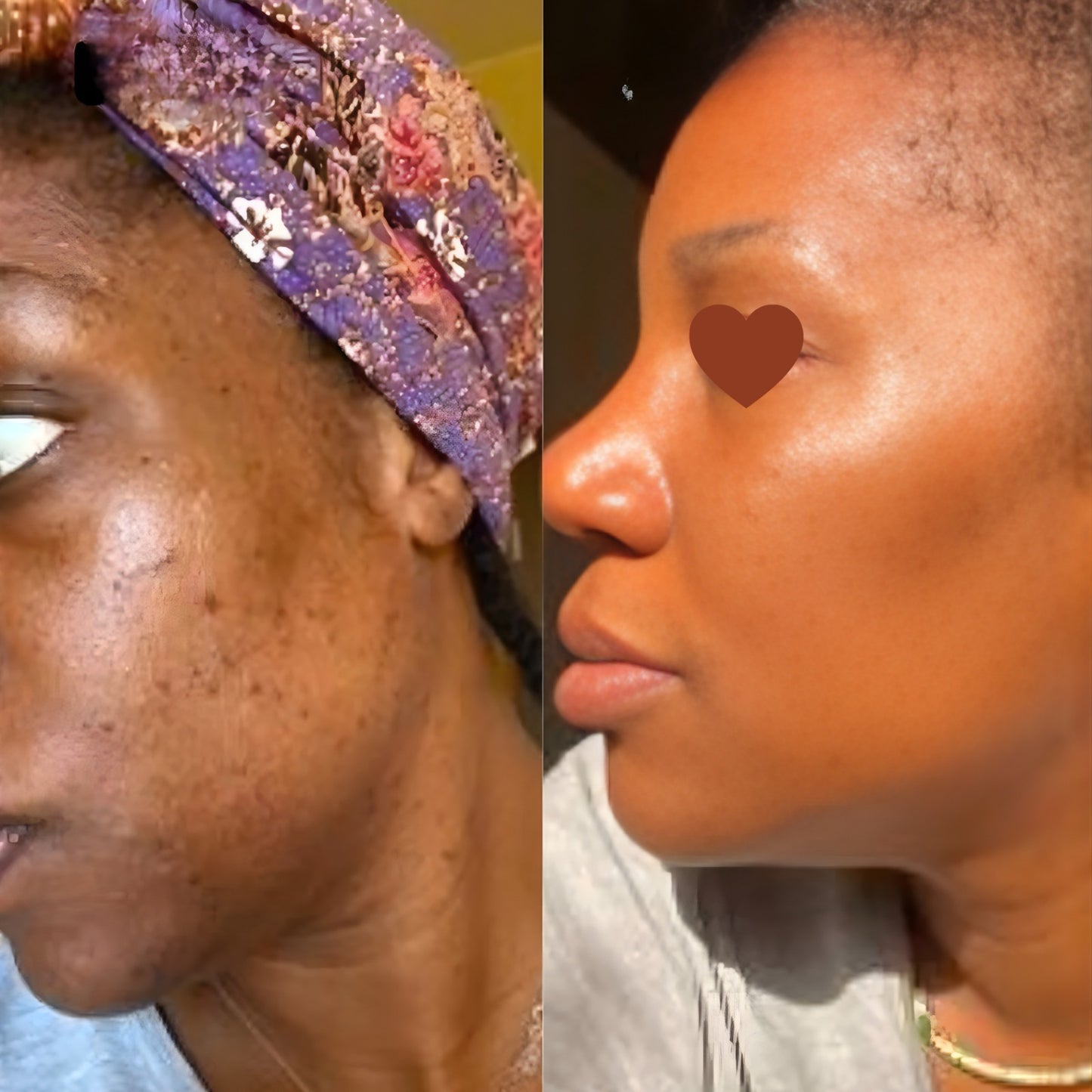 JiYu Toning Polish Pads-Soin pour les taches brunes