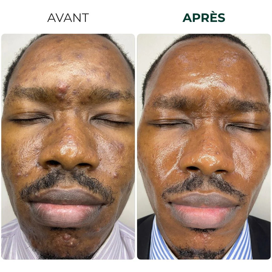 Savon au Curcuma- Peau Radieuse